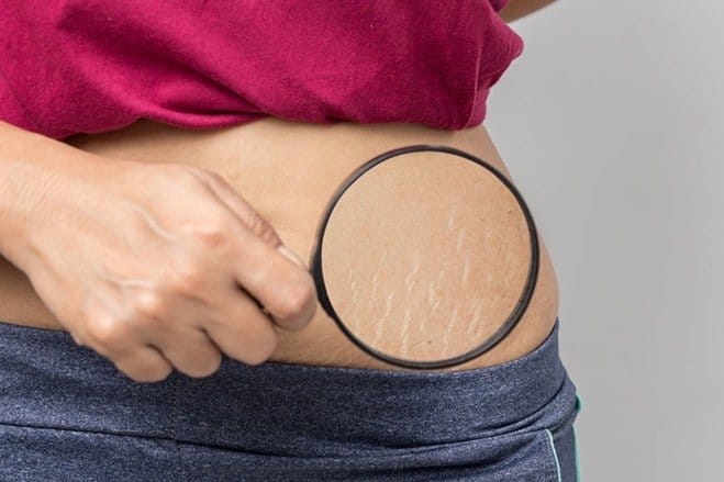 stretch marks on the hip