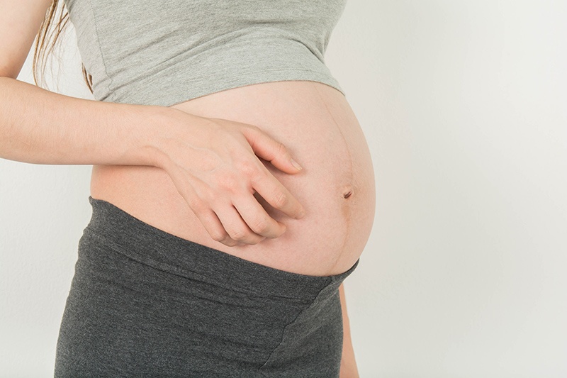 what-to-use-on-itchy-stretch-marks-during-pregnancy-itchy